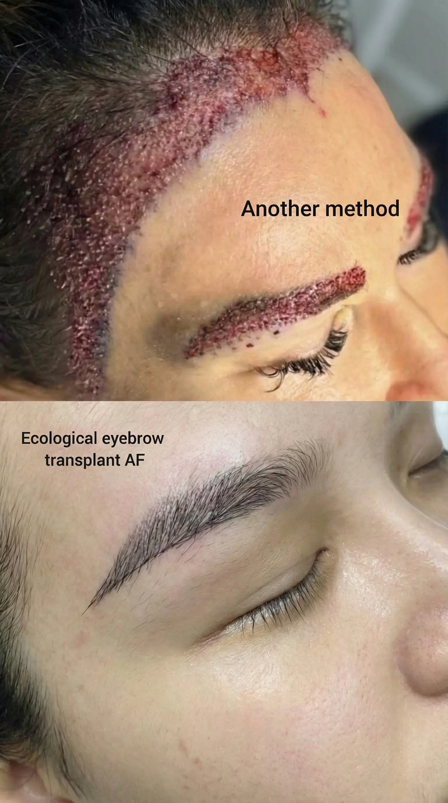 Example of unsuccessful hair transplant from other methods