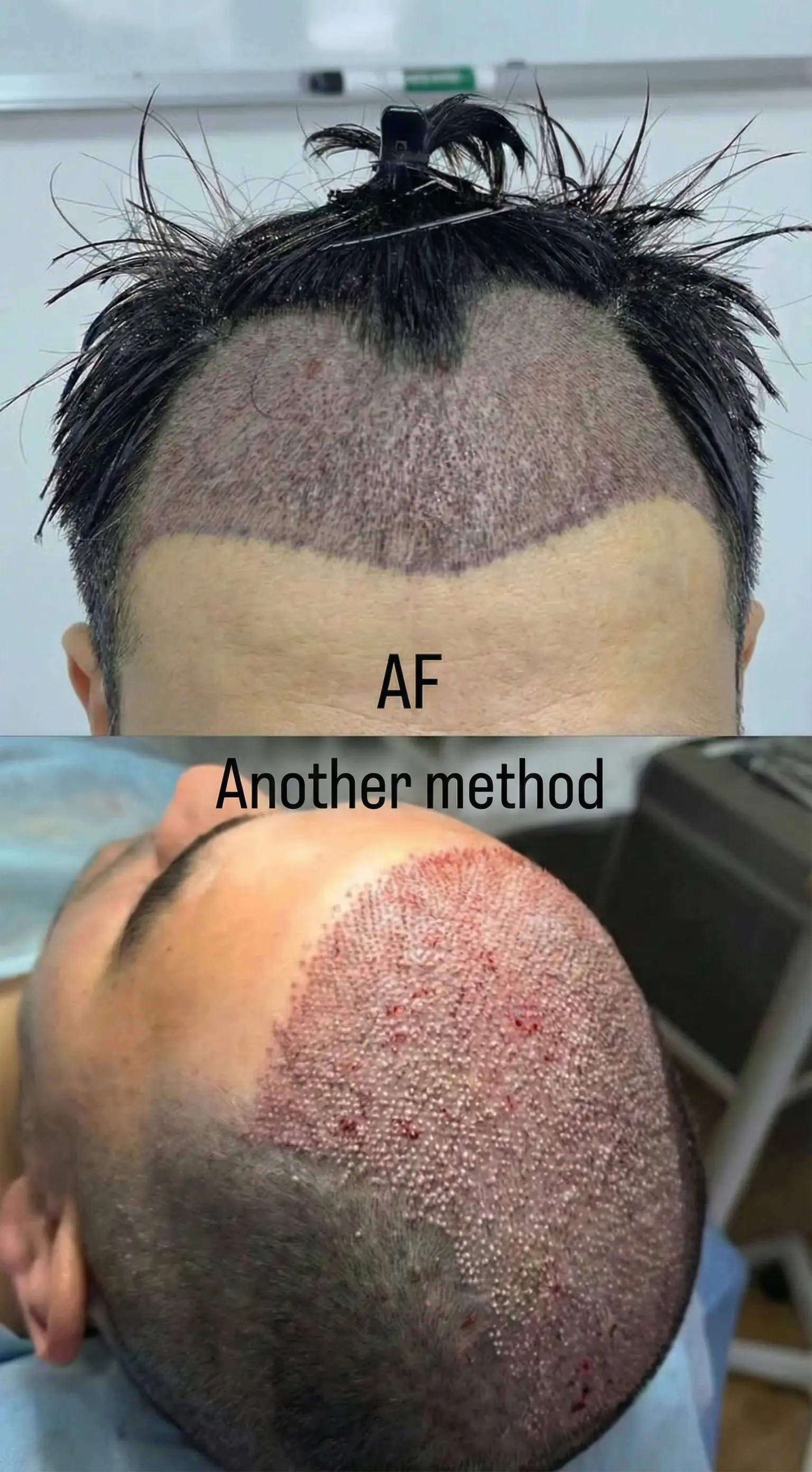 Poor hair transplant density from traditional FUE method