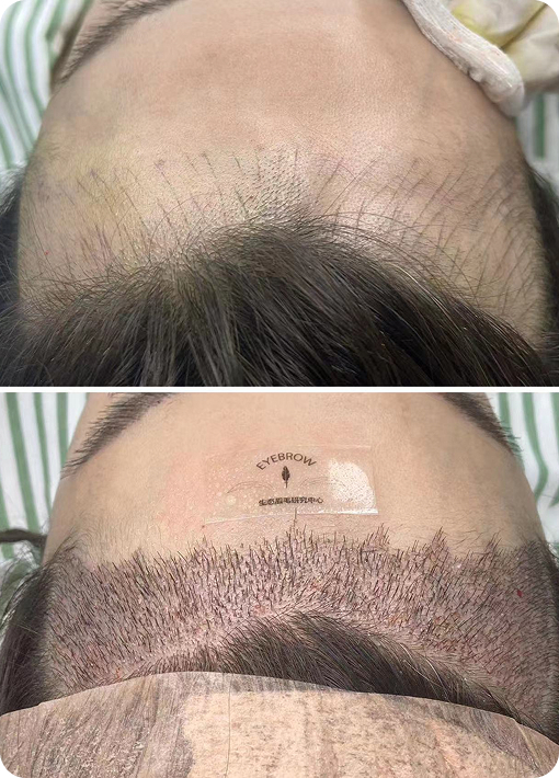 Natural hairline reconstruction with AF technology