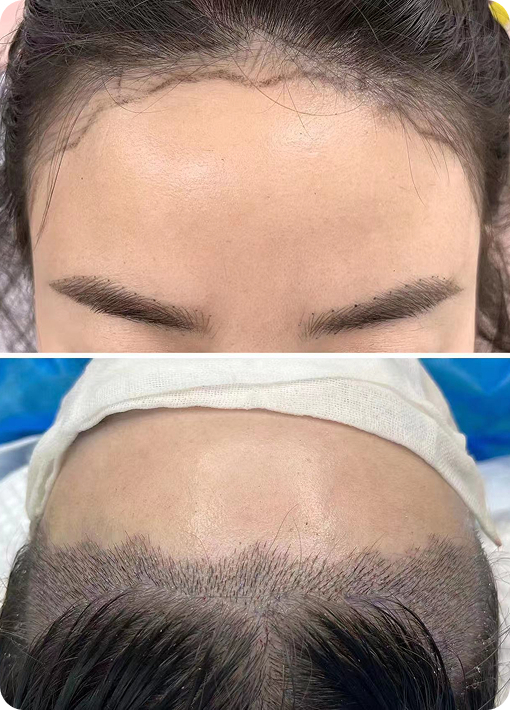 Demonstration of a high hair follicle survival rate