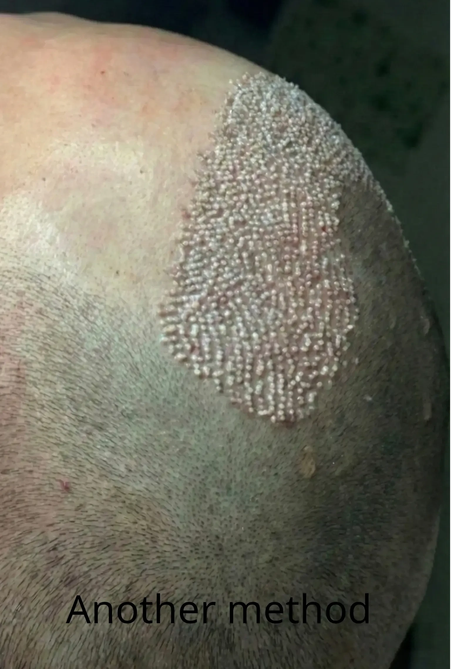 Traditional FUE hair transplant scarring example
